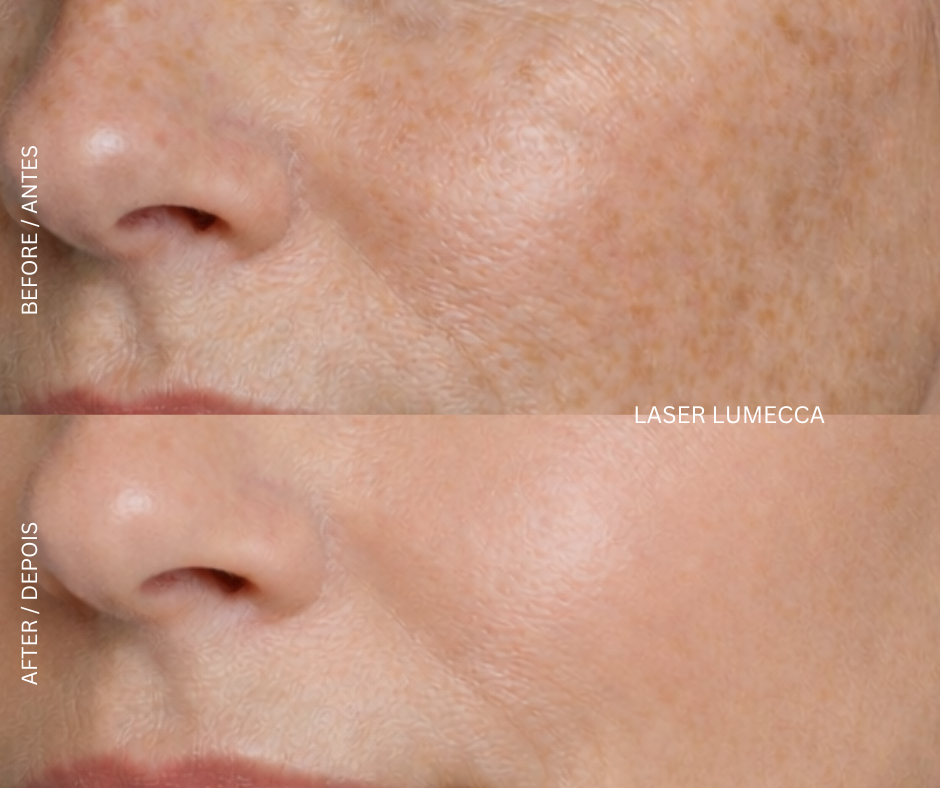 Lumecca IPL 3